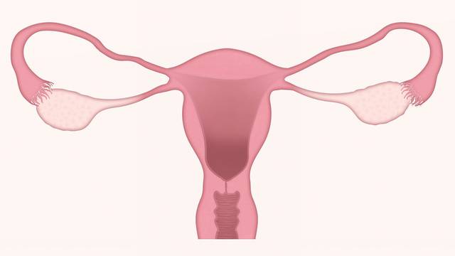 cancer endometrio